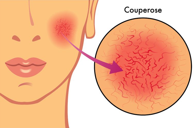 couperose